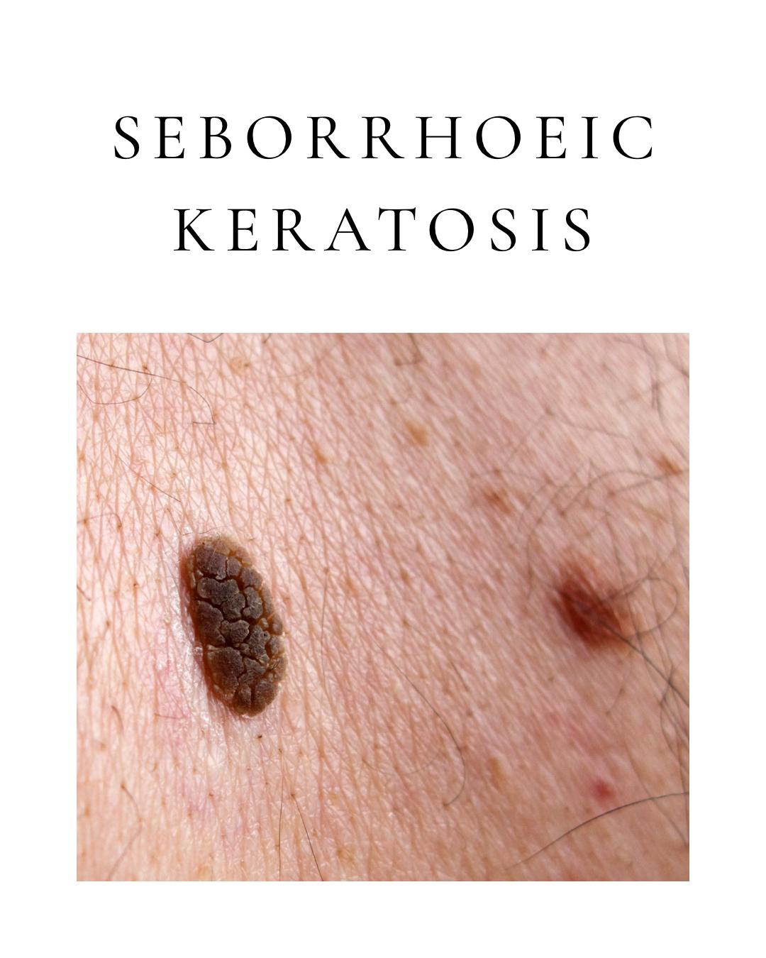 Seborrhoeic Keratosis